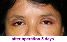 plastic-surgery-blepharoplasty